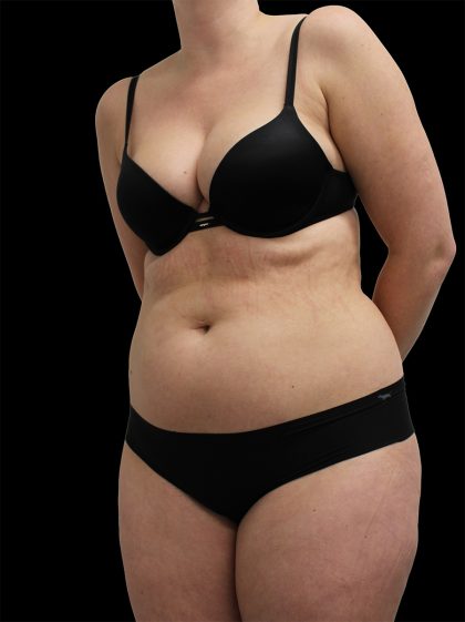 Abdominal Etching Before & After Patient #2397