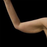Arm Lift Before & After Patient #2415