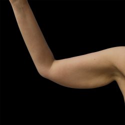 Arm Lift Before & After Patient #2415