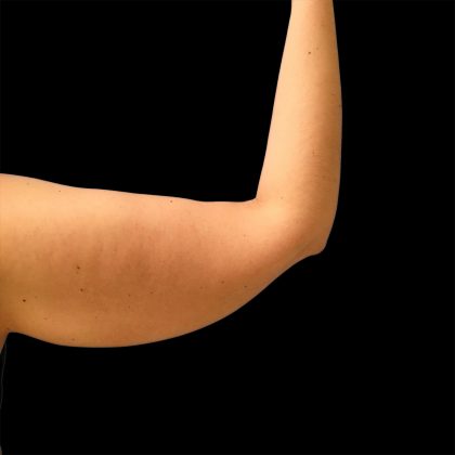 Arm Lift Before & After Patient #2416