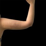 Arm Lift Before & After Patient #2416