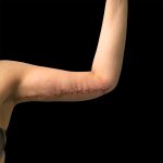 Arm Lift Before & After Patient #2417