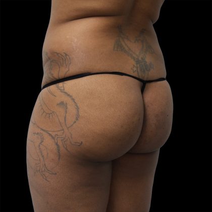 Brazilian Butt Lift Before & After Patient #2432