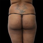 Brazilian Butt Lift Before & After Patient #2432