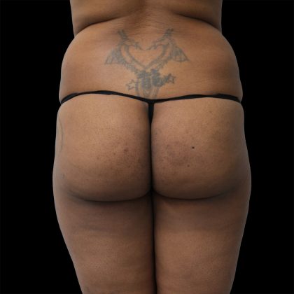 Brazilian Butt Lift Before & After Patient #2432