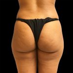 Brazilian Butt Lift Before & After Patient #2425