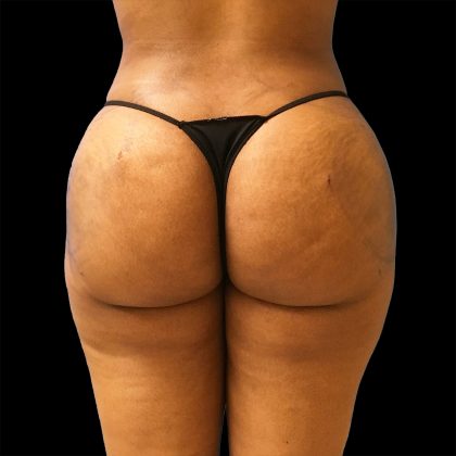 Brazilian Butt Lift Before & After Patient #2425