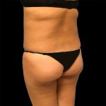 Brazilian Butt Lift Before & After Patient #2426