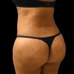 Brazilian Butt Lift Before & After Patient #2426