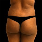 Brazilian Butt Lift Before & After Patient #2427