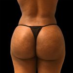 Brazilian Butt Lift Before & After Patient #2427