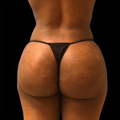 Brazilian Butt Lift Before & After Patient #2427