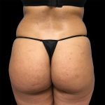 Brazilian Butt Lift Before & After Patient #2428