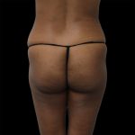 Brazilian Butt Lift Before & After Patient #2429