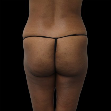 Brazilian Butt Lift Before & After Patient #2429