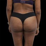 Brazilian Butt Lift Before & After Patient #2429