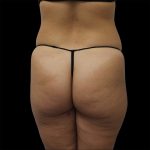 Brazilian Butt Lift Before & After Patient #2430