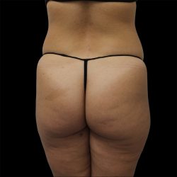 Brazilian Butt Lift Before & After Patient #2430