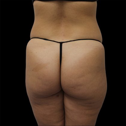 Brazilian Butt Lift Before & After Patient #2430