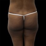 Brazilian Butt Lift Before & After Patient #2431