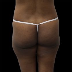 Brazilian Butt Lift Before & After Patient #2431