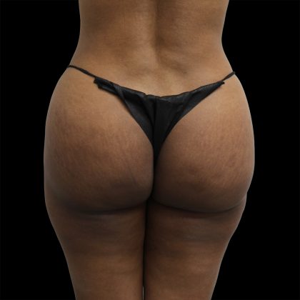 Brazilian Butt Lift Before & After Patient #2431
