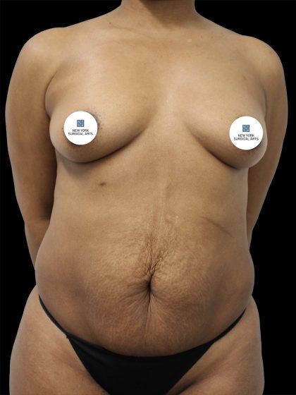 Breast Augmentation Before & After Patient #2460