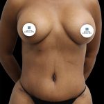 Breast Augmentation Before & After Patient #2460