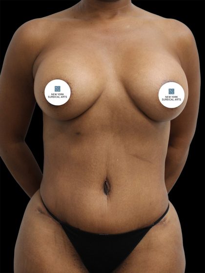 Breast Augmentation Before & After Patient #2460