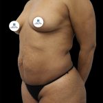 Breast Augmentation Before & After Patient #2460