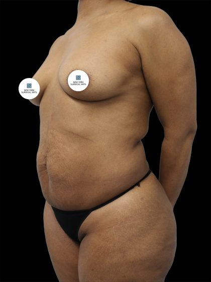 Breast Augmentation Before & After Patient #2460