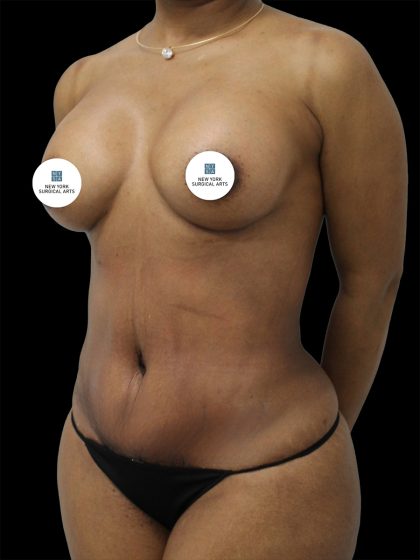 Breast Augmentation Before & After Patient #2460