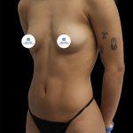 Breast Augmentation Before & After Patient #2455