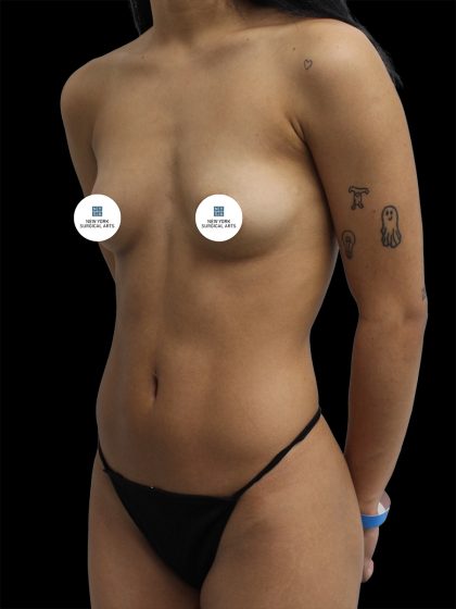 Breast Augmentation Before & After Patient #2455