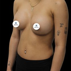 Breast Augmentation Before & After Patient #2455