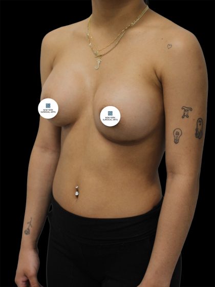 Breast Augmentation Before & After Patient #2455