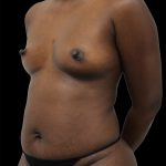 Breast Augmentation Before & After Patient #2456