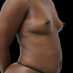 Breast Augmentation Before & After Patient #2456