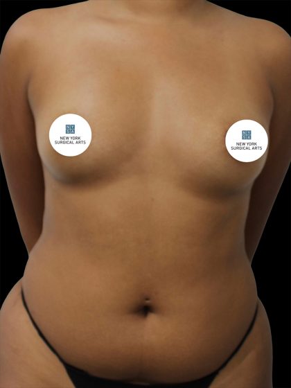Breast Augmentation Before & After Patient #2457