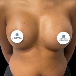 Breast Augmentation Before & After Patient #2457