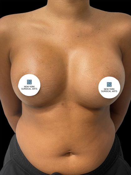 Breast Augmentation Before & After Patient #2457