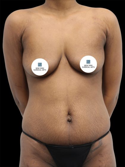 Breast Augmentation Before & After Patient #2458