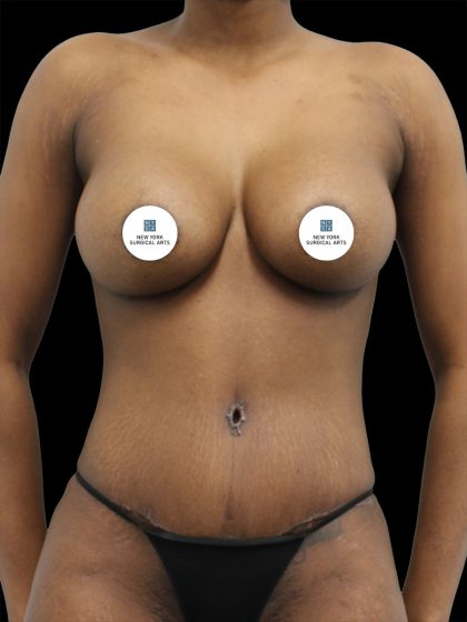 Breast Augmentation Before & After Patient #2458