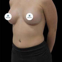 Breast Augmentation Before & After Patient #2459