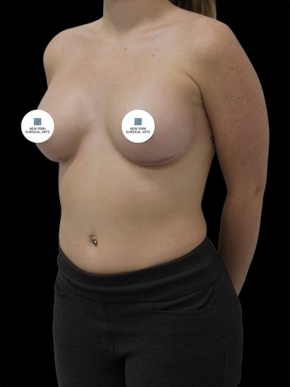 Breast Augmentation Before & After Patient #2459