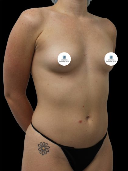 Breast Augmentation Before & After Patient #2459