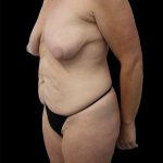 Breast Lift Before & After Patient #2487