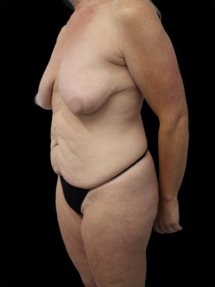 Breast Lift Before & After Patient #2487