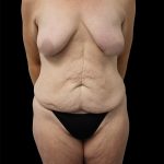 Breast Lift Before & After Patient #2487