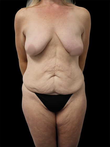 Breast Lift Before & After Patient #2487